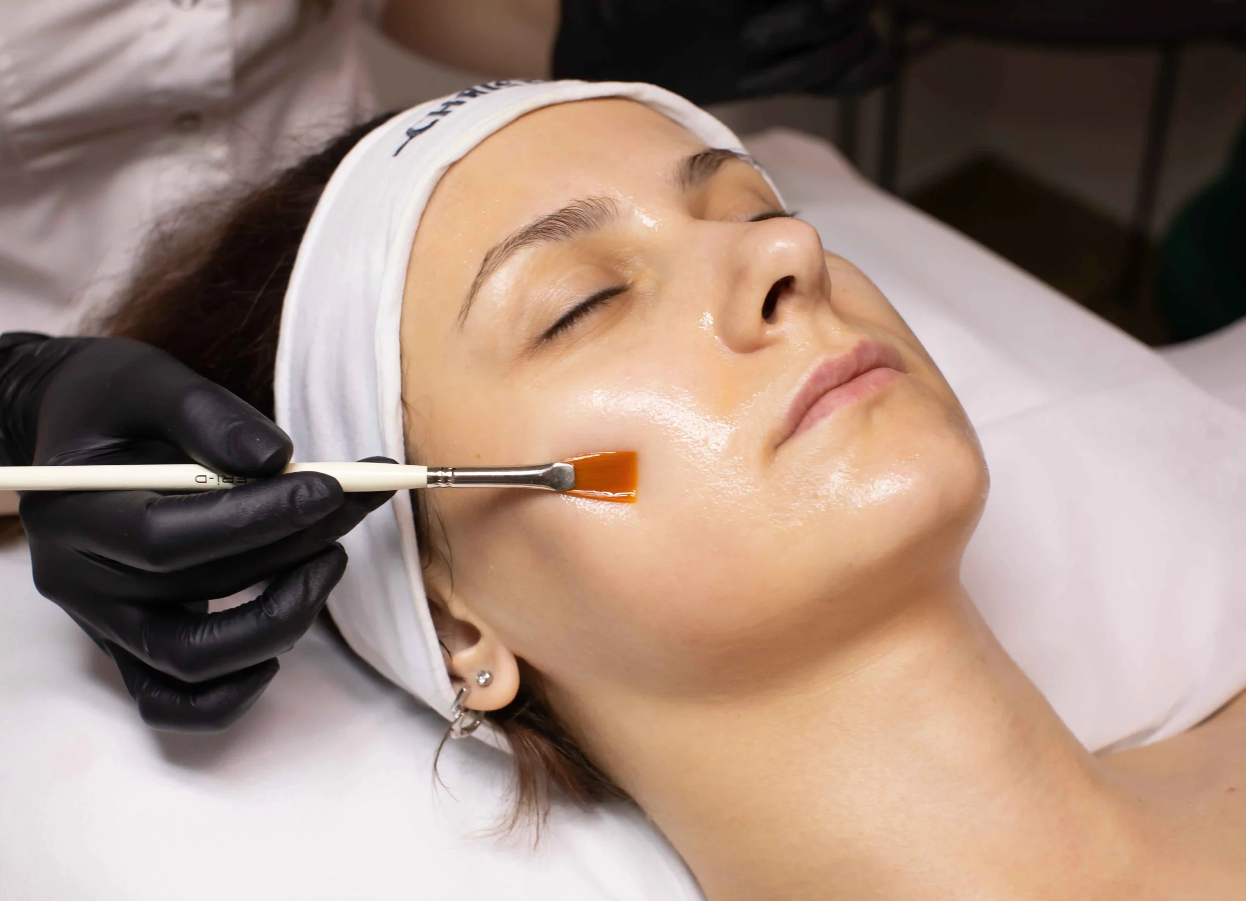 Chemical Peels Treatment