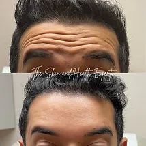 Smooth Fuse In Red Bank, NJ | Viafuse Flawless Texture Erase