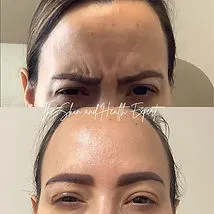 Smooth Fuse In Red Bank, NJ | Viafuse Flawless Texture Erase