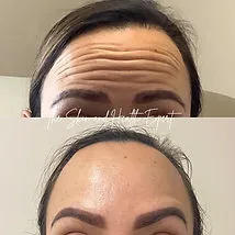 Smooth Fuse In Red Bank, NJ | Viafuse Flawless Texture Erase
