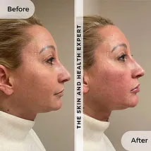 Chin-Lip-Filer