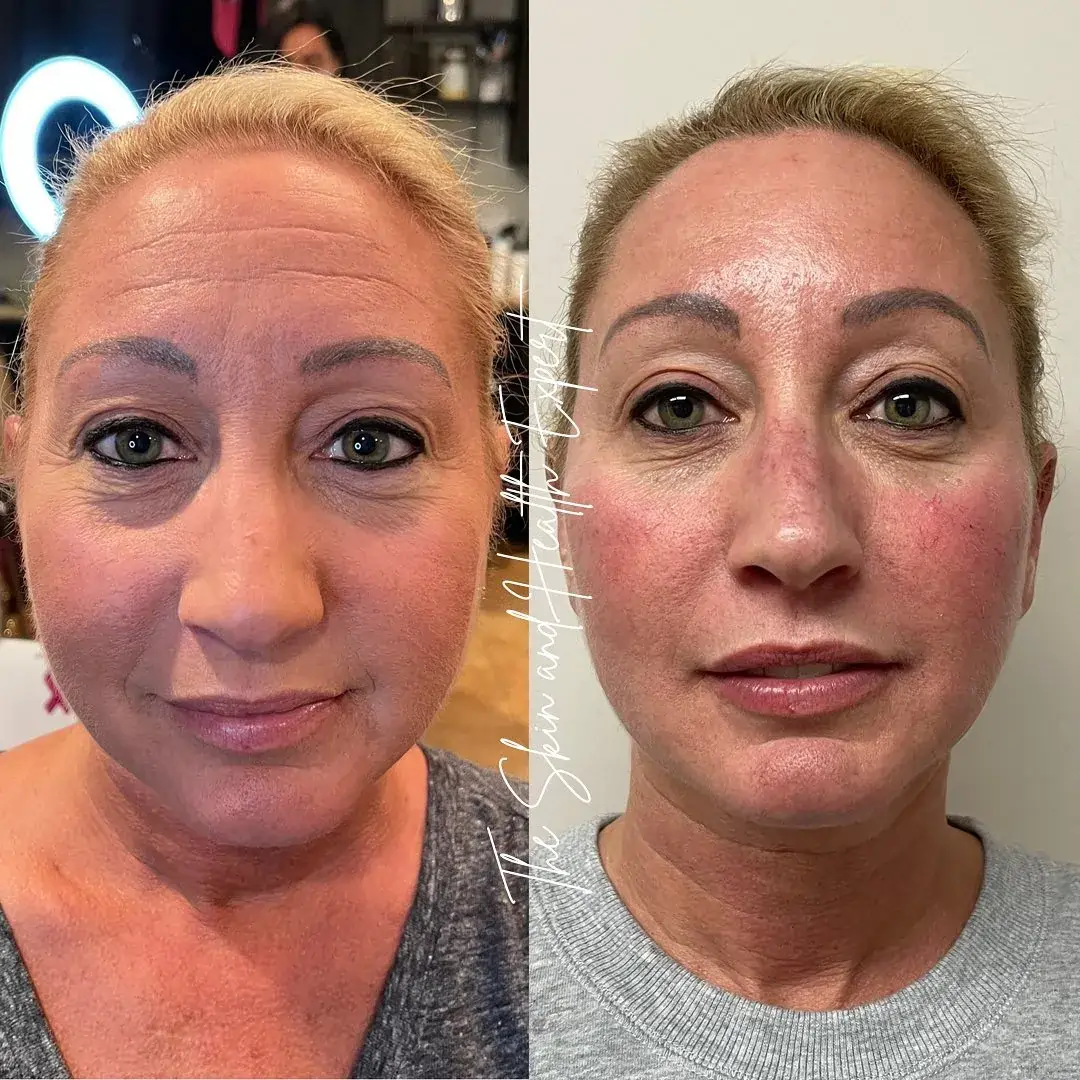 Filler-Tox-before-after-in-red-bank-nj