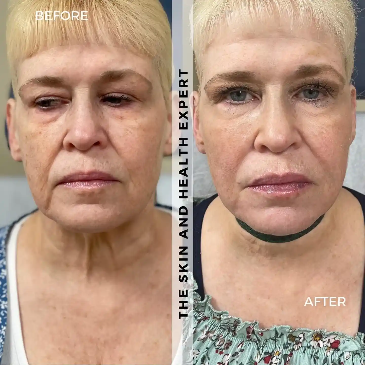 Filler-Tox-before-and-after-in-red-bank-nj-a