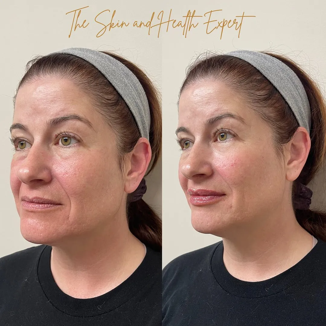 Filler-Tox-before-and-after-in-red-bank-nj