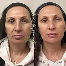 Lower-Face-Filler