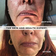 Tox-Filler