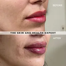 lip-filler-five